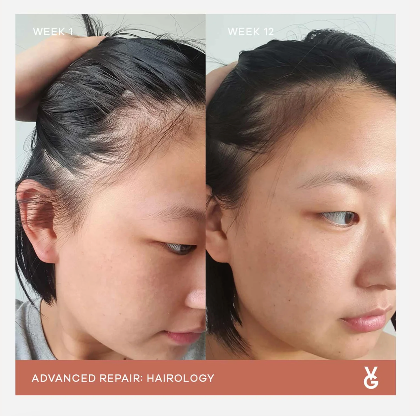 VIDA GLOW: HAIROLOGY CAPSULES ANAGAIN HAIR GROWTH SUPPLEMENT